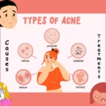 ADULT ACNE: 15 facts of Acne | Types, Causes, Treatments